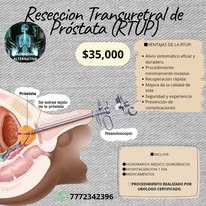 Cirugía de apéndice por laparoscopia